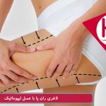 لاغری ران با عمل لیپوماتیک