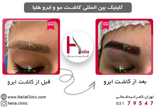 Eyebrow-implantation-by-FUT-method