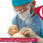 پیوند مو بدون درد و جراحی و خونریزی
