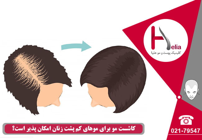 کاشت مو برای موهای کم پشت زنان