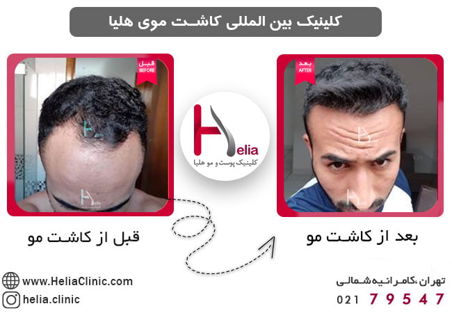 کاشت مو برای موی کم پشت مردان