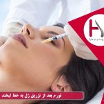 تورم بعد از تزریق ژل به خط لبخند
