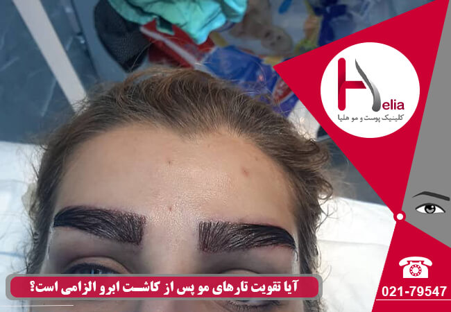 Strengthen-hair-and-eyebrow-strands-after-eyebrow-implantation