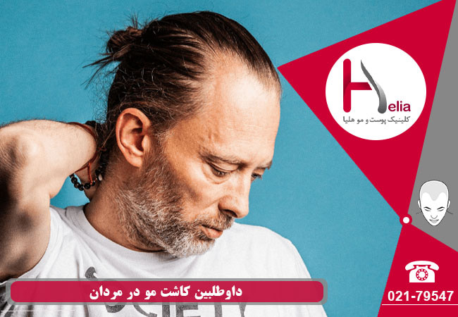 داوطلبین کاشت مو در ایران