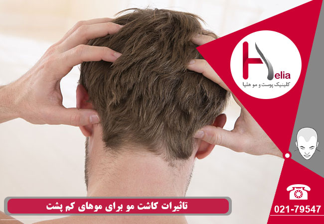 اثرات کاشت مو بر موهای کم پشت