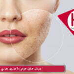 درمان جای جوش با تزریق چربی به پوست صورت