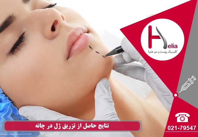 نتایج حاصل از ترانسفر ژل در چانه