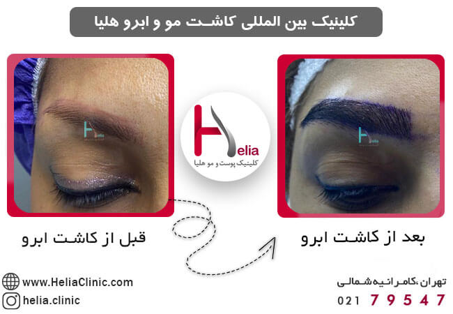 Eyebrow implantation in a reputable clinic