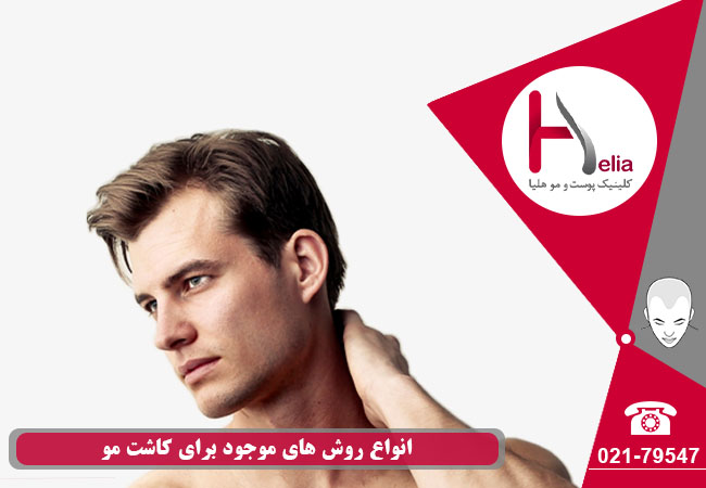 A variety of methods available for hair transplantation
