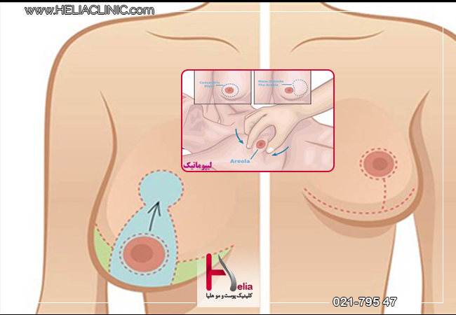لیپوماتیک سینه در زنان
