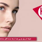 نتیجه تزریق چربی بعد از چه مدت قابل مشاهده است؟