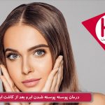 درمان پوسته پوسته شدن ابرو بعد از پیوند ابرو طبیعی