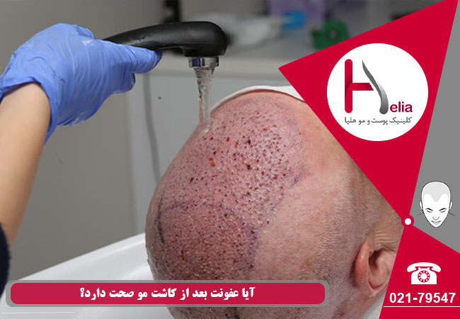 آیا زخم های ایجاد شده پس از کاشت موی طبیعی باعث عفونت در ناحیه تحت درمان خواهد شد