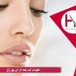 عفونت لب بعد از تزریق ژل