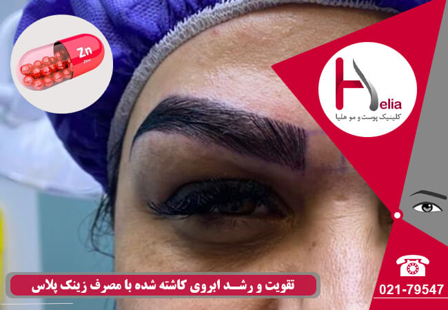 تقویت موی کاشته شده ابرو با ویتامین
