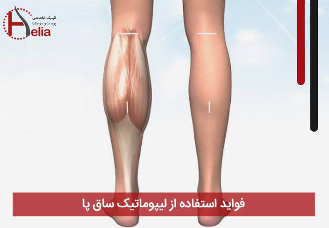 فواید استفاده از لیپوماتیک ساق پا