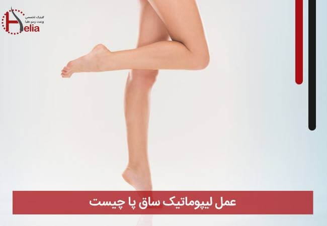عمل لیپوماتیک ساق پا چیست