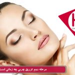 مرحله دوم تزریق چربی چه زمانی است