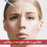 جلوگیری از حالت تهوع بعد از بوتاکس