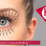 عمل بلفاروپلاستی بدون درد و خونریزی
