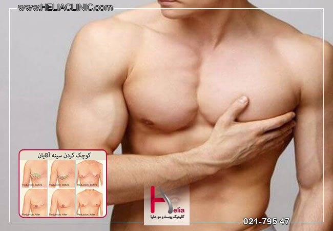 عمل کوچک کردن سینه در مردان