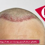 راهنمای درمان قرمزی پوست سر بعد از پیوند موی طبیعی