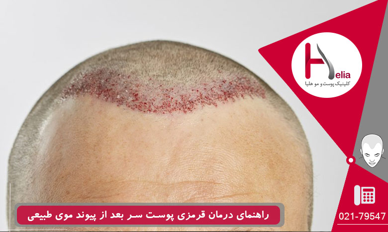 راهنمای درمان قرمزی پوست سر بعد از پیوند موی طبیعی