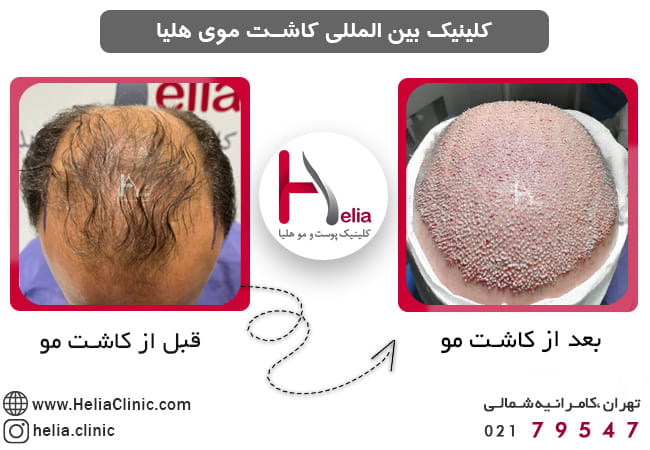 مرکز پیوند موی مورد تایید وزارت بهداشت و درمان در تهران و ایران