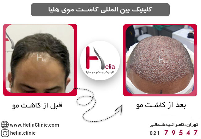 کاشت مو با تجهیزات پیشرفته در تهران