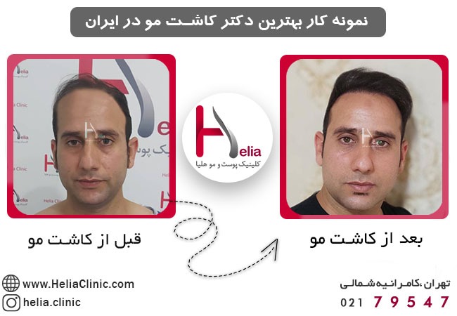 نمونه کار بهترین دکتر کاشت مو در ایران