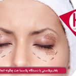 بلفاروپلاستی با دستگاه پلاسما جت چگونه انجام می شود؟