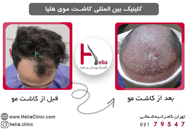 آیا مراکز کاشت مو زیر نظر وزارت بهداشت قابل اطمینان هستند؟
