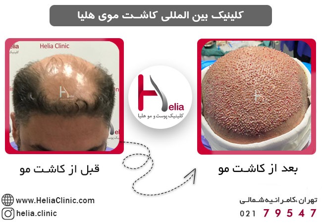 روش های جدید پیوند موی طبیعی در بهترین مراکز تهران