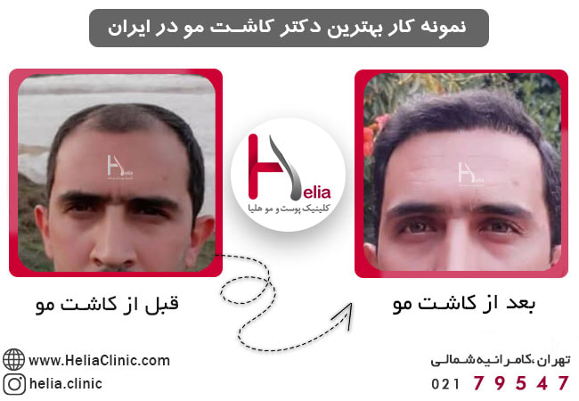 عکس قبل و بعد کاشت مو توسط بهترین دکتر در تهران