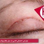 عوارض احتمالی ناشی از عمل بلفاروپلاستی
