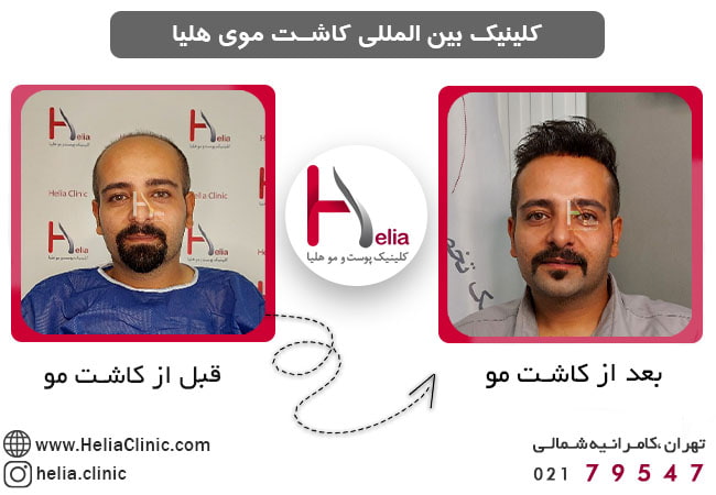 کلینیک منتخب و معتبر پیوند مو در تهران