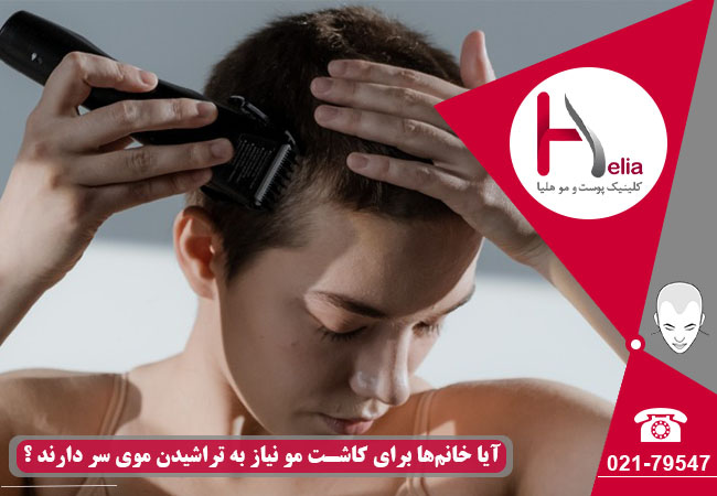 تراشیدن سر زنان برای پیوند مو