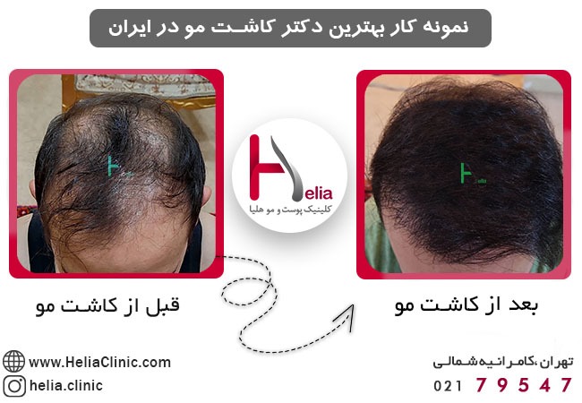 نمونه کار بهترین دکتر مورد تایید انجمن کاشت موی ایران