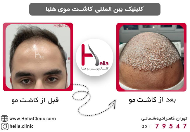بهترین مرکز تخصصی کاشت مو در تهران و ایران
