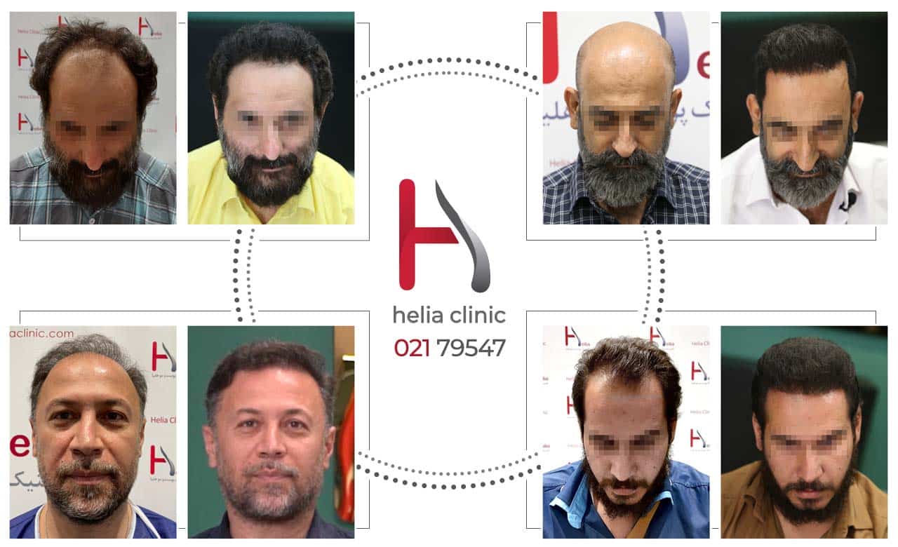پیشرفته ترین کلینیک کاشت مو در تهران و ایران