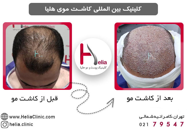 عکس نتیجه کاشت مو در کلینیک تهران