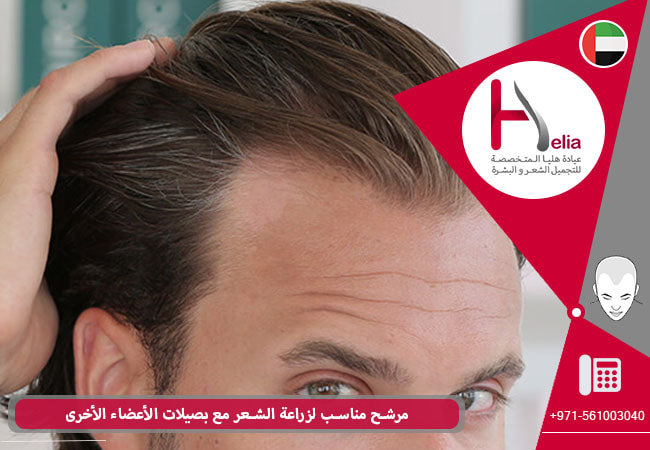 مرشح مناسب لزراعة الشعر مع بصيلات الأعضاء الأخرى