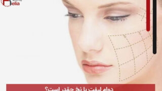 دوام لیفت با نخ چقدر است