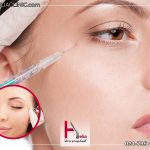 میزان تکرار تزریق بوتاکس