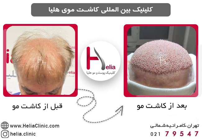 نمونه کاشت مو در افراد با سن بالا
