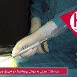 برداشت چربی به روش لیپوماتیک و تزریق چربی همزمان