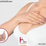 ماموپلاستی بدون پروتز