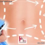 مراقبت های بعد از ابدومینوپلاستی