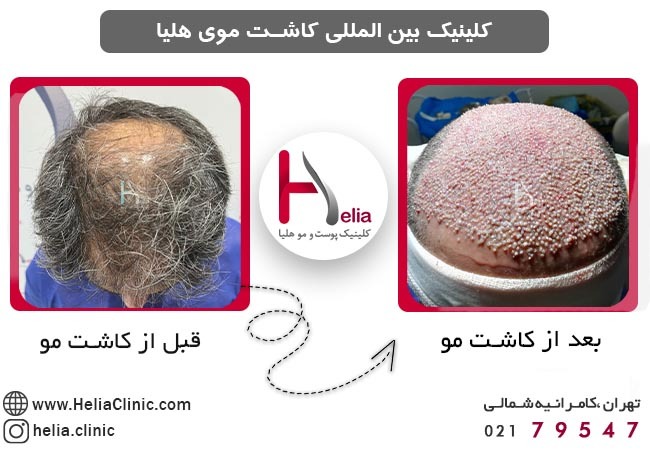 مراقبت های بعد از پیوند مو در افراد سالمند