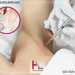 مراقبت بعد از بوتاکس زیر بغل